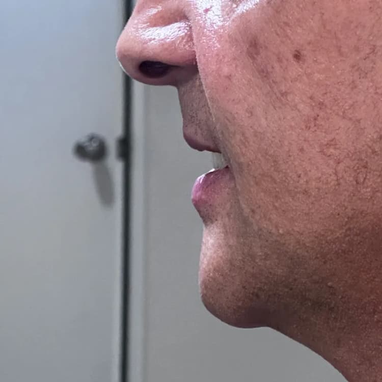 After Complete Smile Makeover with Veneers