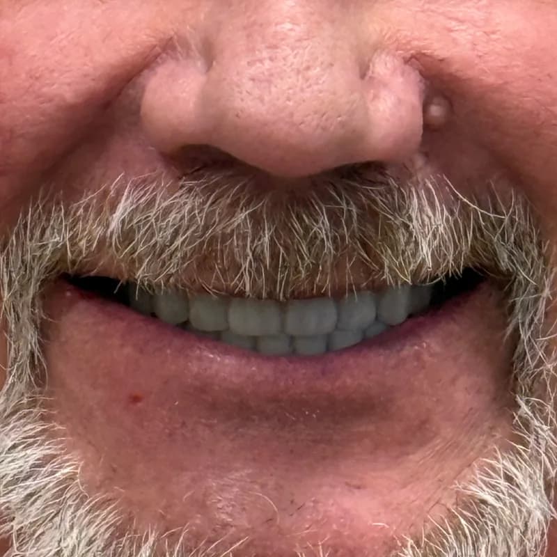 Before All-on-4 Full Arch Restoration
