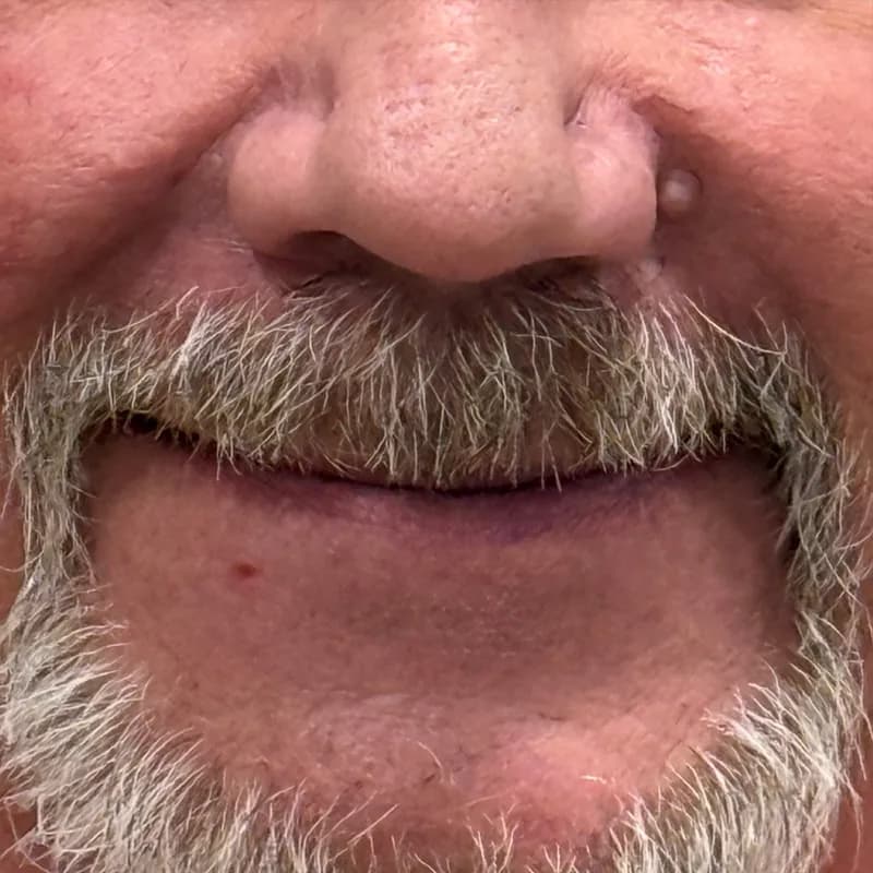 After All-on-4 Full Arch Restoration