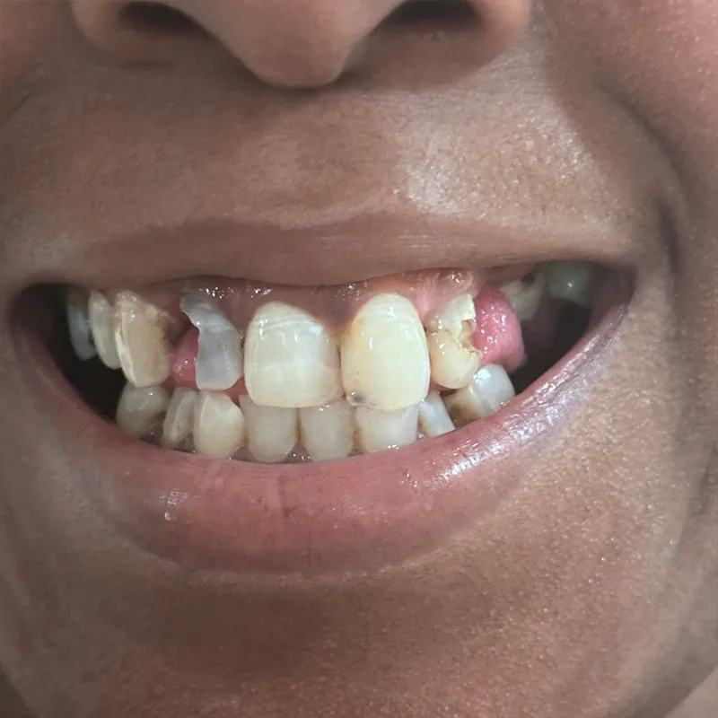 After Crown Lengthening & Veneers