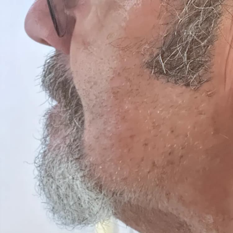 After Cosmetic Crown Replacement